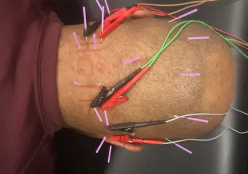 A person with some wires attached to their leg.